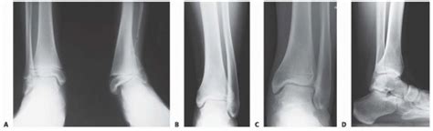 Distal Tibial Osteotomy | Musculoskeletal Key