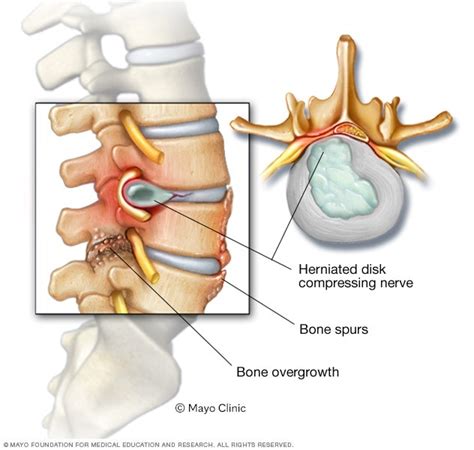 Spinal stenosis - Symptoms and causes - Mayo Clinic