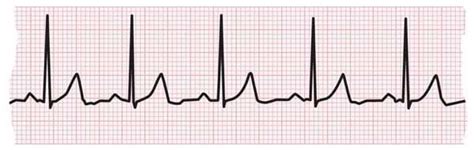 Electrocardiogram (ECG or EKG) | American Heart Association