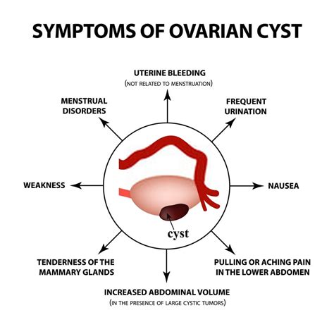 Ruptured Ovarian Cyst Discharge