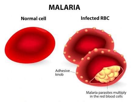 Genotypes (AA,AS,SS) and Malaria Proneness – Information Parlour