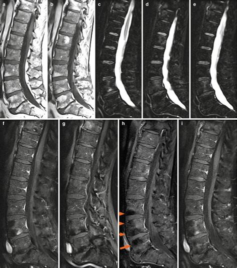 Ankylosing Spondylitis | Radiology Key