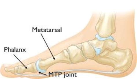 Turf Toe - OrthoInfo - AAOS