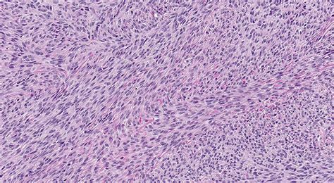 Fibroma Histology