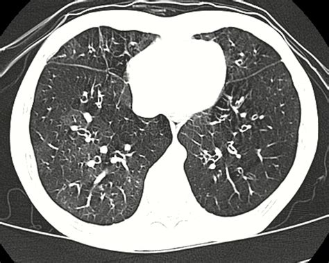 Bronchiolitis obliterans - Wikipedia