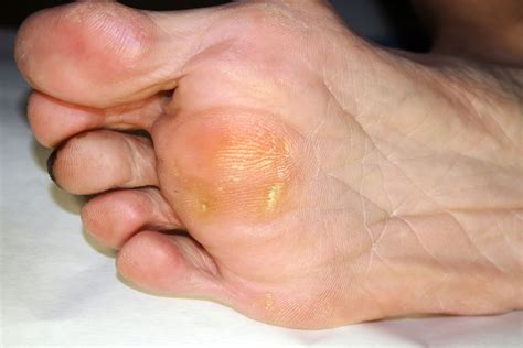 All You Need to Know About Painful Corns & Callous | Procare Podiatric Medicine & Surgery