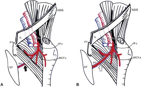 Extending the use of the gracilis muscle flap in perineal ...