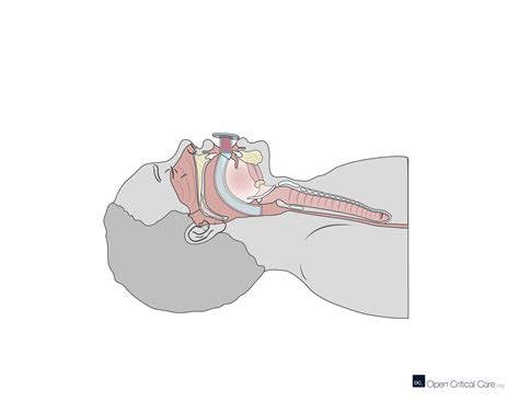 Sagittal cross section view of oral airway - Open Critical Care