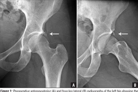 Figure 1 from Acute severe hip pain associated with labral calcific ...