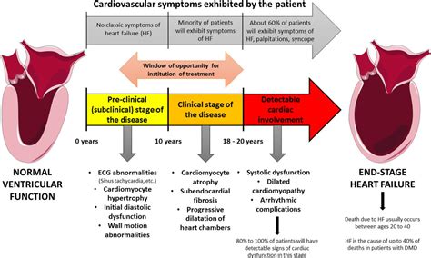 A current approach to heart failure in Duchenne muscular dystrophy | Heart