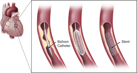 Coronary Angioplasty and Stenting - Lim Ing Haan Cardiology Clinic