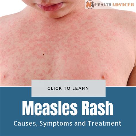 Measles Rash : Causes, Picture, Symptoms and Treatment