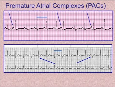 Sinus rhythm with pac ecg 671152-Sinus rhythm with pac treatment