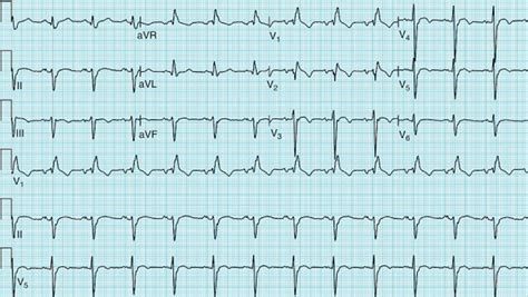 decidir Estrecho de Bering Furioso trifascicular block prognosis dramático micrófono Garganta