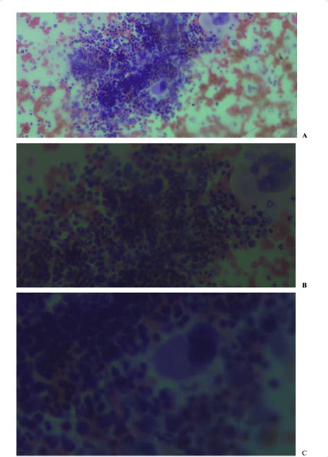 Bone marrow aspirate cytology slides as viewed by light microscope at ...