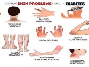 Skin Infections & Skin Conditions Caused By Diabetes