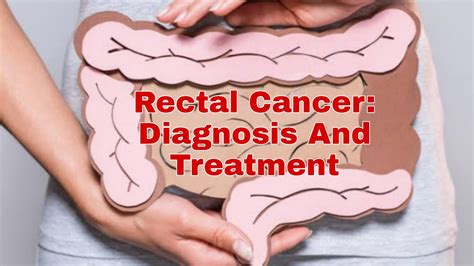 Rectal Cancer: Diagnosis And Treatment- Part 1 - SuccessYeti