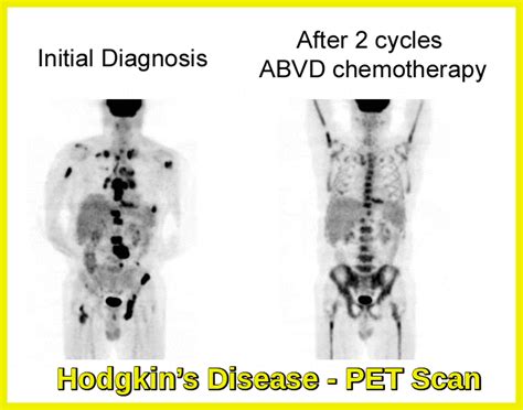 Hodgkin’s Disease | Ask Hematologist | Understand Hematology