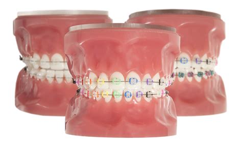 Ceramic Braces – Ames & Peterson Orthodontics