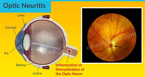 Optic Neuritis or Retrobulbar Neuritis | Causes | Signs | Treatment | Epidemiology