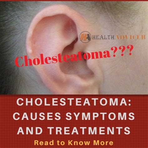 Cholesteatoma : Causes, Picture, Symptoms And Treatment