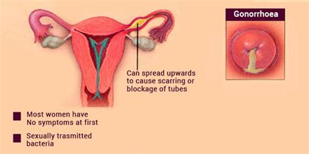 Gonorrhea - Causes | Gonorrhea Symptoms - Men & Women | Treatment