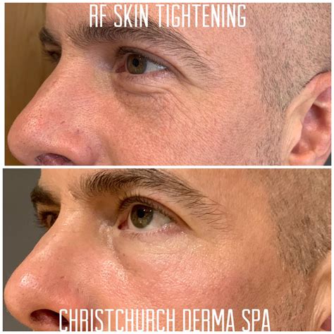 Skin Tightening in Christchurch, Dorset at Christchurch Derma Spa