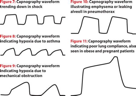 How to Read and Interpret End-Tidal Capnography Waveforms