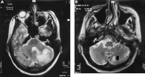 Multiple large and small cerebellar infarcts | Journal of Neurology ...