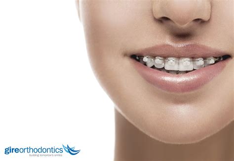 Everything You Need to Know About Ceramic Braces