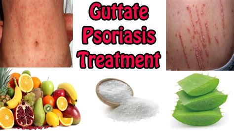 Guttate Psoriasis Treatment - Best Cure For Guttate Psoriasis With ...