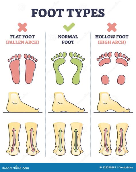 Foot Types with Flat, Normal and Hollow Feet Comparison in Outline Diagram Stock Vector ...