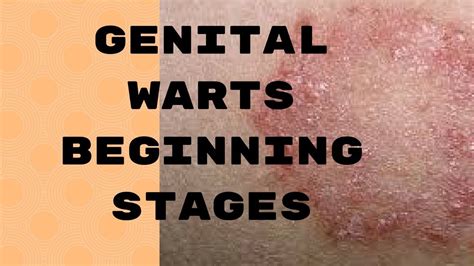 How Long Does The Genital Warts Virus Live On Surfaces at Stephen Placencia blog