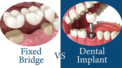 Implants or traditional dental prosthetics - Alpha Dent Implants