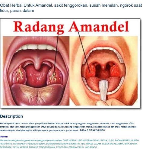 Radang Tenggorokan Akut – newstempo