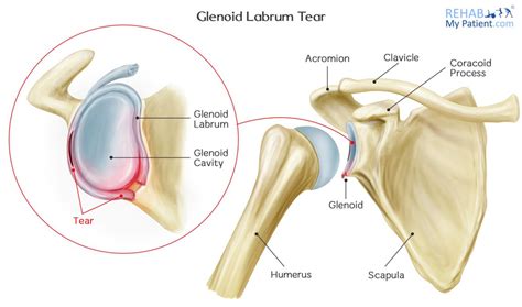 Diagram Of Shoulder Labrum / Slap Tears Orthopaedic Surgery Of The Shoulder