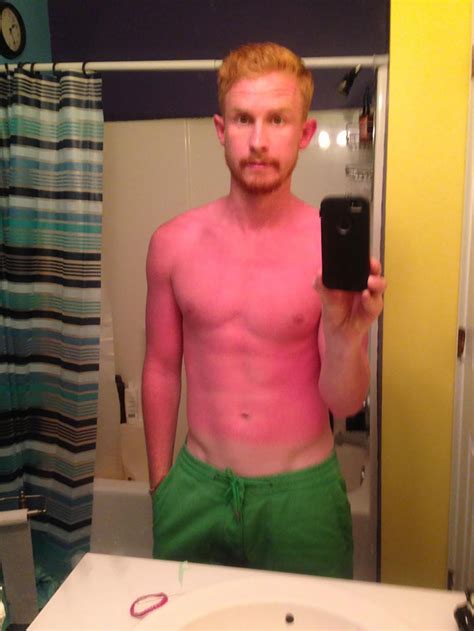 30 People Who Realized The Importance Of Sunscreen The Hard Way | DeMilked