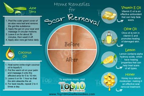 Home Remedies for Scar Removal | Top 10 Home Remedies