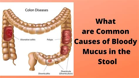 What are Common Causes of Bloody Mucus in the Stool - YouTube