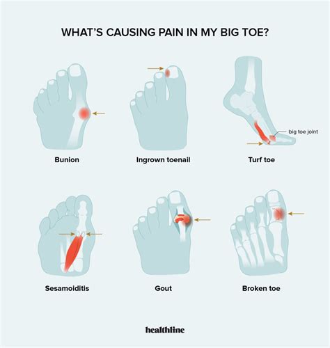 Hallux Rigidus Treatment: *Exercises, Inserts And Surgery*, 60% OFF