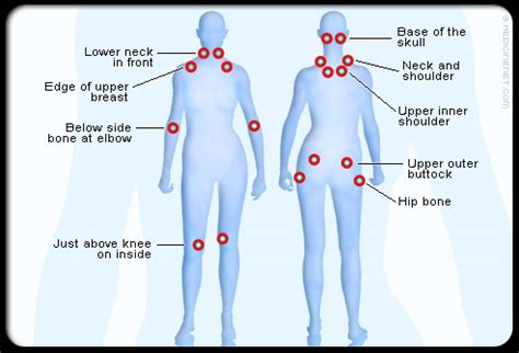 Fibromyalgia Pain Points