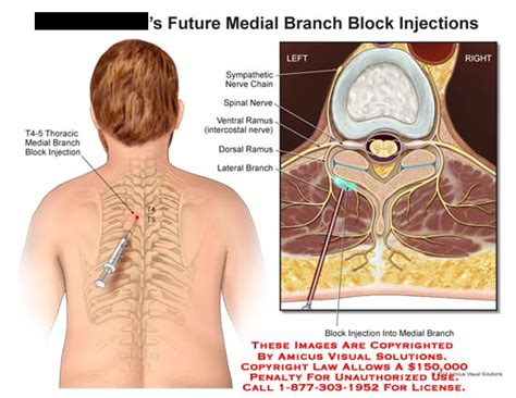 AMICUS Illustration of amicus,injection,future,medial,branch,block,T4-5 ...