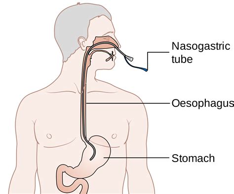 nasogastric (NG) feeding tubes - Ashtons Hospital Pharmacy