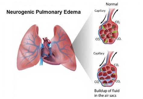 Neurogenic Pulmonary Edema | Causes, Symptoms and Treatment - Healthella