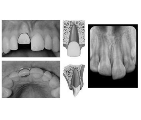 Dental Trauma Classification