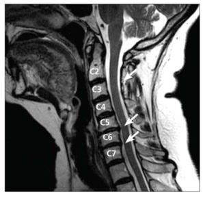 EMG Best Test for Cervical Radiculopathy (Pinched Nerves) | Neuro Testing Group