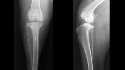 Patellar Luxation & Malalignment - KYON