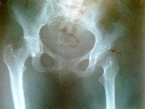 Femoral Head Fractures - Trauma - Orthobullets