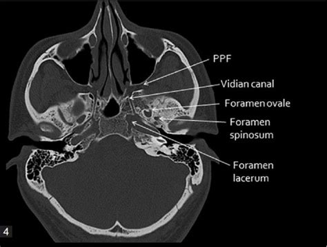 Fossa pterigopalatina | Medicina247