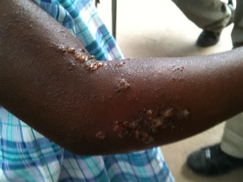 Scabies On Dark Skin | Images and Photos finder